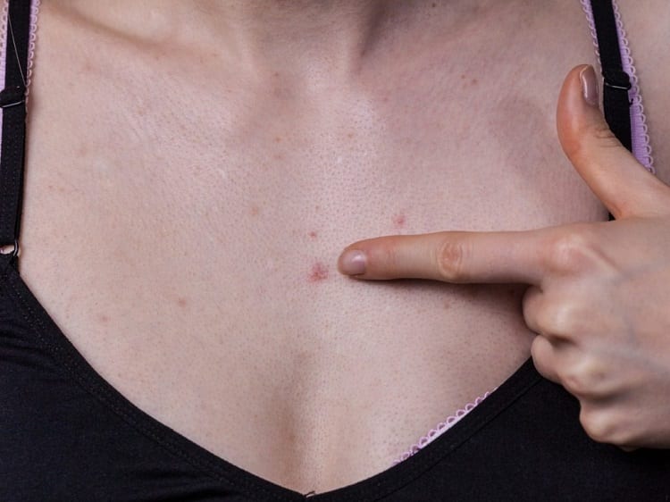 What is Chest Acne?