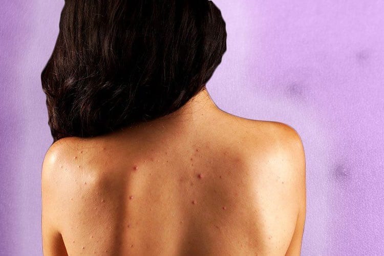 WHAT IS BACK ACNE A SIGN OF?